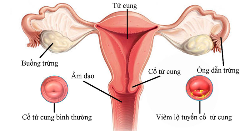 Dấu hiệu viêm lộ tuyến cổ tử cung là gì