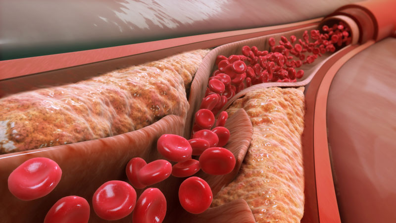Ldl cholesterol trong xét nghiệm máu là gì