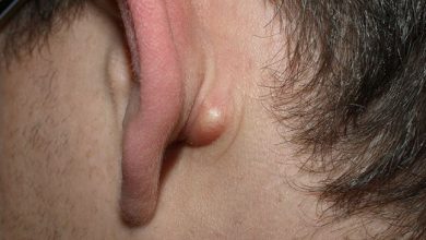 Mọc mụn ở vành tai là bệnh gì