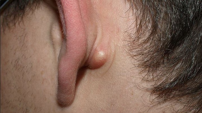 Mọc mụn ở vành tai là bệnh gì